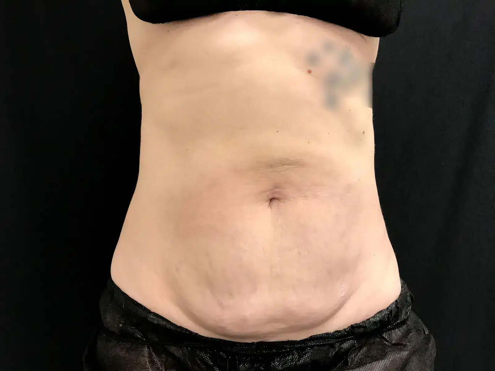 Close-up image of a person's abdomen showing skin texture, including stretch marks and slight contour variations, against a black background. The individual is wearing a black crop top and shorts, highlighting body diversity and natural skin appearance.
