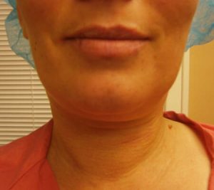 Close-up of a woman's lower face and neck, showcasing smooth skin and natural lip color, with a surgical cap visible in the background, indicating a medical or cosmetic procedure setting.
