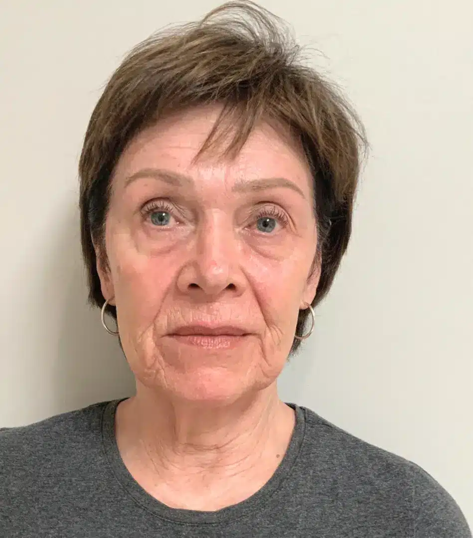 Close-up portrait of an older woman with short, dark hair and light skin, wearing a gray t-shirt and silver hoop earrings. She has a neutral expression and is looking directly at the camera against a plain light-colored background. The image highlights her facial features, including subtle wrinkles and blue eyes, reflecting the natural aging process. This image can be used in discussions about aging, skincare, or health topics related to older adults.