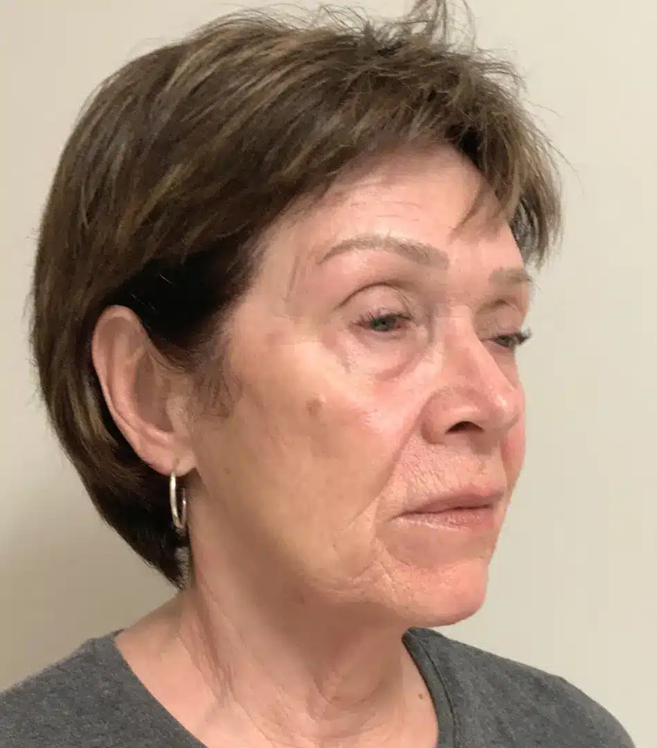 Profile view of an older woman with short, brown hair, wearing a gray shirt and silver hoop earrings. She has a neutral expression and is facing slightly to the right. The background is a light, neutral color, providing contrast to her features. This image may be used to discuss topics related to aging, skincare, or beauty treatments.
